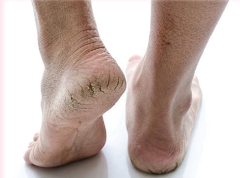 cracked heels