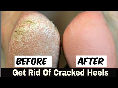 cracked heels