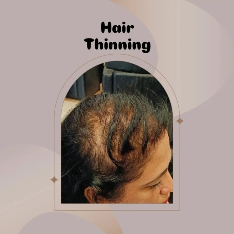 hair thinning